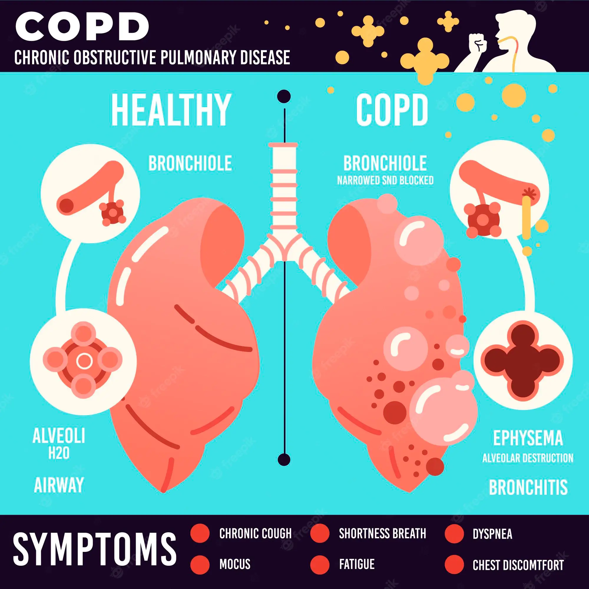 Erfahre mehr über die Anzeichen von COPD
