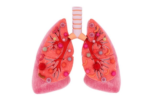 Leben mit Pulmonale Hypertonie